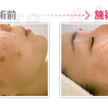 宇都宮市 Premier Beauty Clinicのビフォーアフター 宇都宮市 Premier Beauty Clinicのビフォーアフター