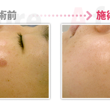 宇都宮市 Premier Beauty Clinicのビフォーアフター 宇都宮市 Premier Beauty Clinicのビフォーアフター